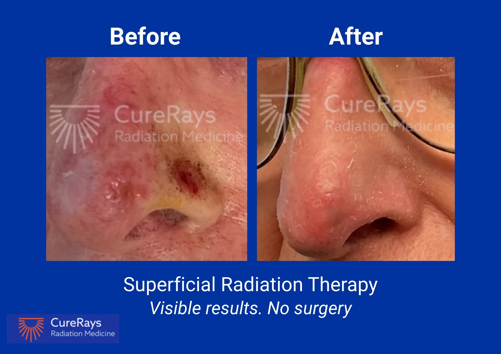 Before and after superficial radiation therapy — nose